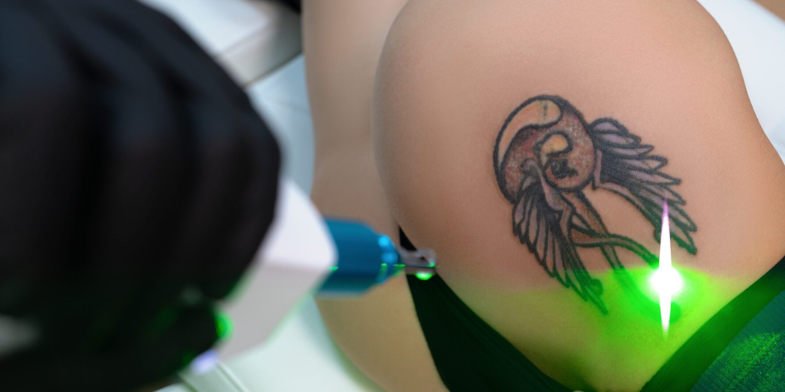 Are There Any Harmful Effects of Laser Tattoo Removal Treatment?