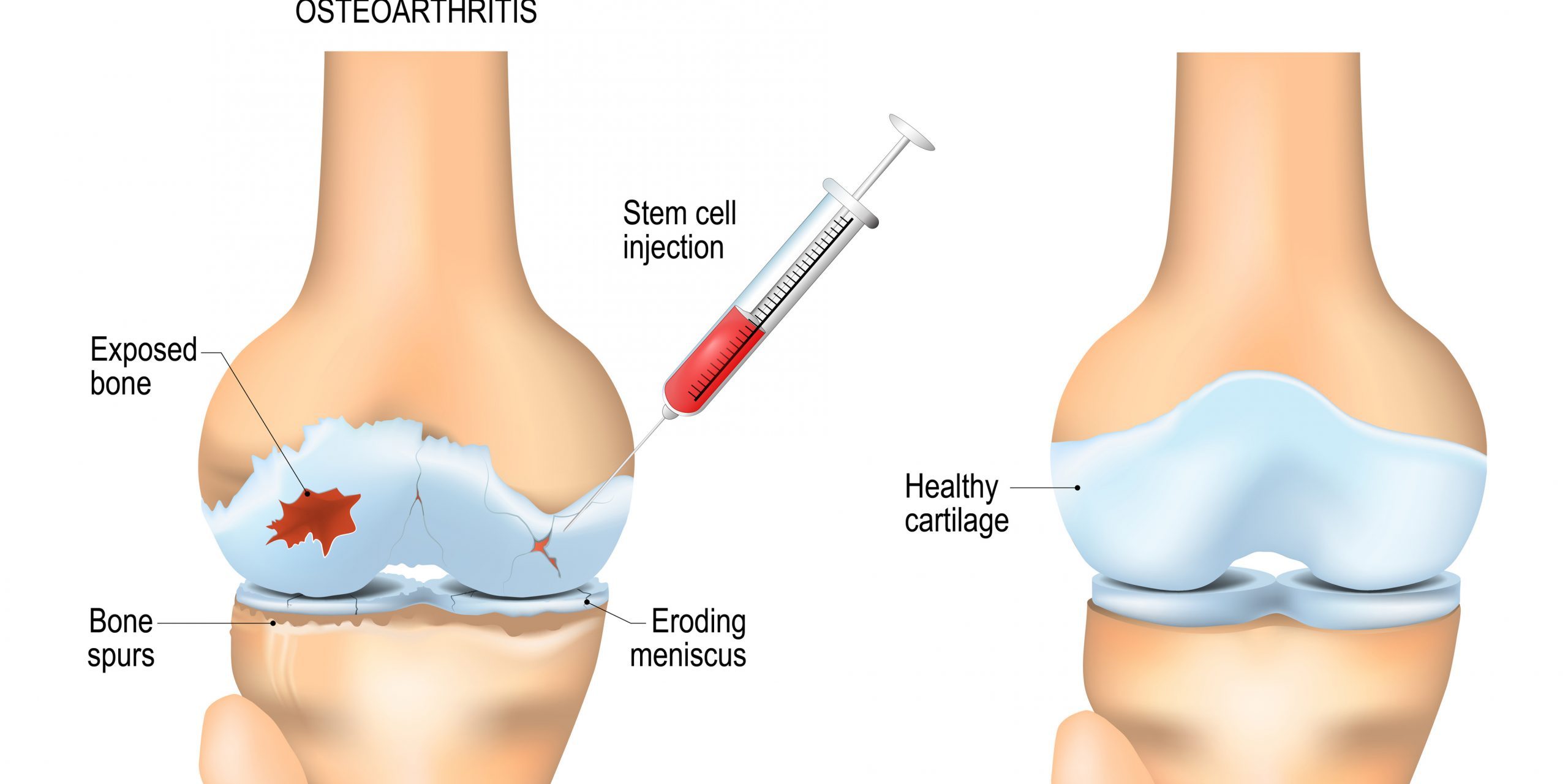 Is Stem Cell Therapy for Arthritis Safe and Effective?