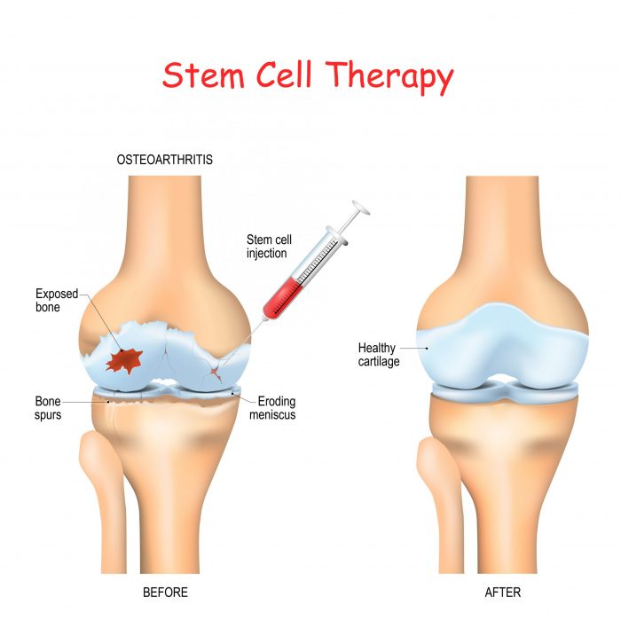 Is Stem Cell Therapy for Arthritis Safe and Effective?