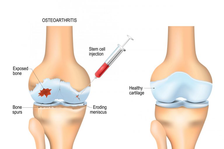 Is Stem Cell Therapy for Arthritis Safe and Effective?