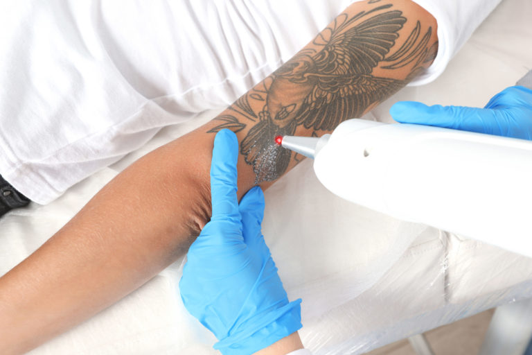 Laser Tattoo Removal - Does It Leave A Scar? | EC Medical Group