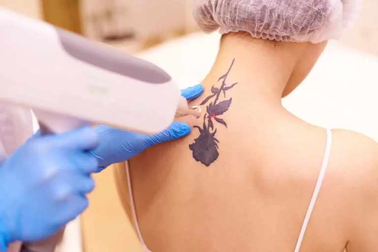 Laser Tattoo Removal by EC Medical Group in Santee CA