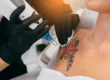 Laser Tattoo Removal Services in Santee, CA by EC Medical Group