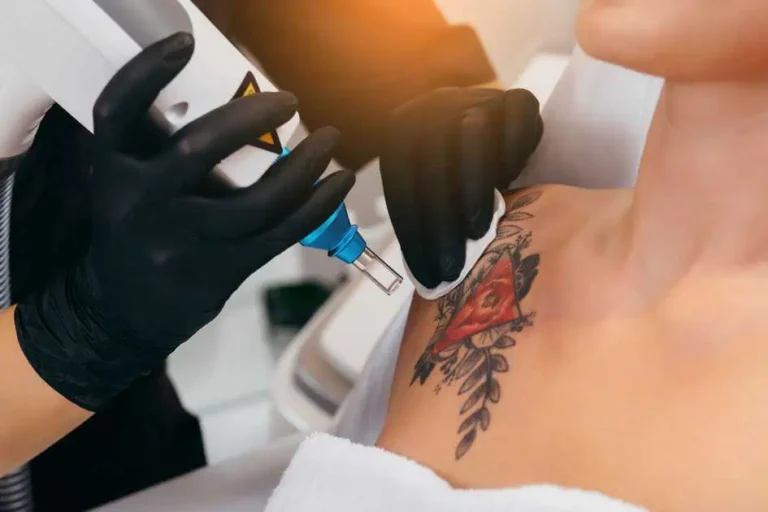 Laser Tattoo Removal Services in Santee, CA by EC Medical Group