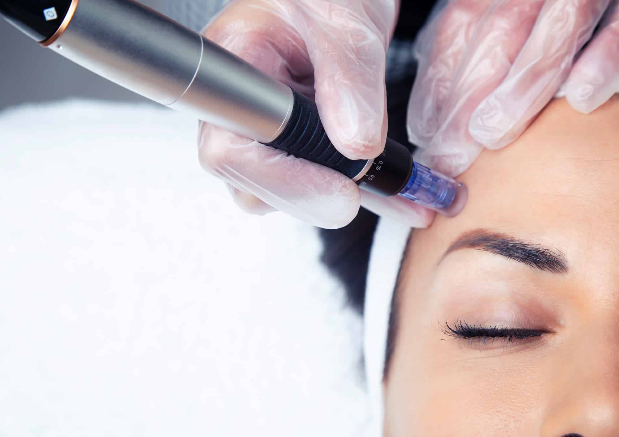 Woman Recieving Dermapen Treatment in Santee by EC Medical Group
